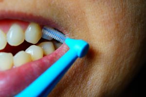 Hoe kan je tandplak verwijderen op moeilijk bereikbare plekken